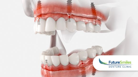 How to Care for Your Denture Implants: Maintenance Tips and Tricks
